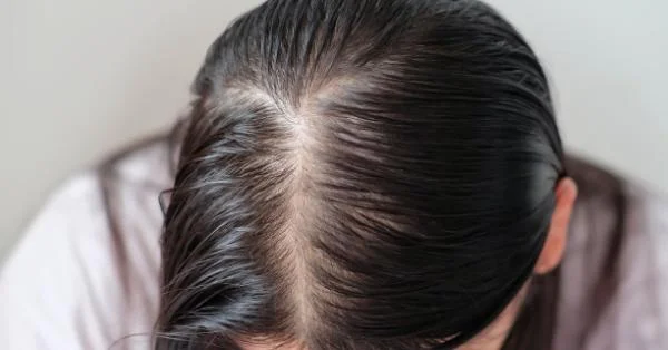 Happy #HairCareGoals: How to Get Rid of Lice in Hair?